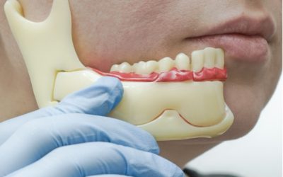 Máte málo kosti pro zubní implantáty? Tohle jsou vaše možnosti
